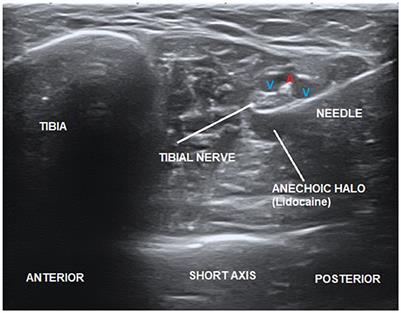 The role of ultrasound-guided perineural injection of the tibial nerve with a sub-anesthetic dosage of lidocaine for the diagnosis of tarsal tunnel syndrome